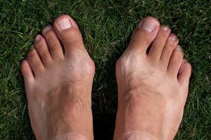 The Real Cause of Bunions, and Their Treatment