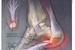 Plantar Fascia