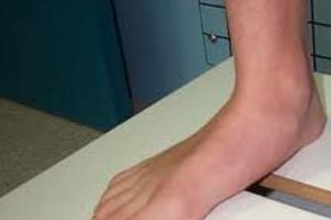 Flat Feet – Causes, Prevention, and Treatment