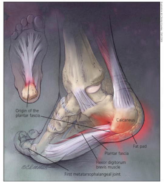 Plantar Fascia