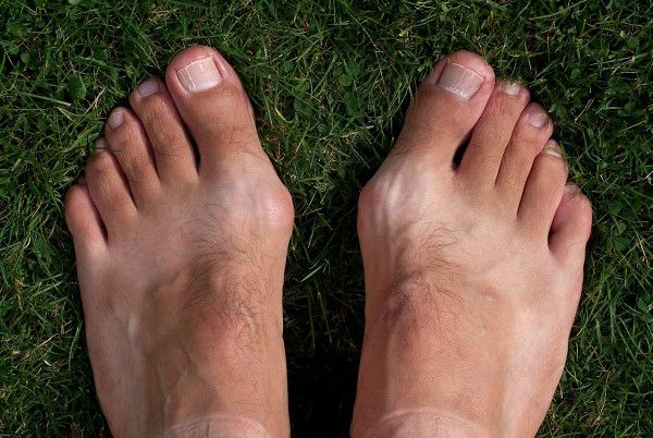 What are the causes of bunions?